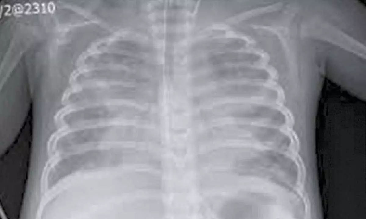 Three-yr-old overcomes extremely rare critical complications