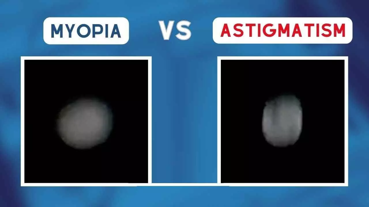 Sharp rise in myopia and astigmatism cases in capital Sharp rise in myopia and astigmatism cases in capital