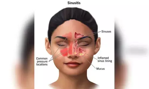 Surgery more effective in treating chronic sinus than antibiotics: Study