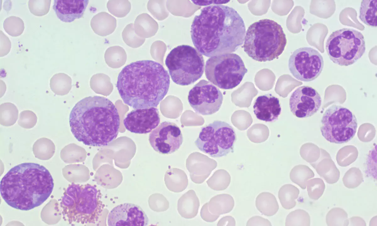 CML Treatment Goals Are Evolving: Why Deeper Responses and Quality of Life Matter More Than Ever