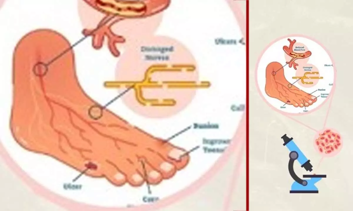Nagaland University researchers find plant compound to treat diabetic wound, foot ulcers Nagaland University researchers find plant compound to treat diabetic wound, foot ulcers