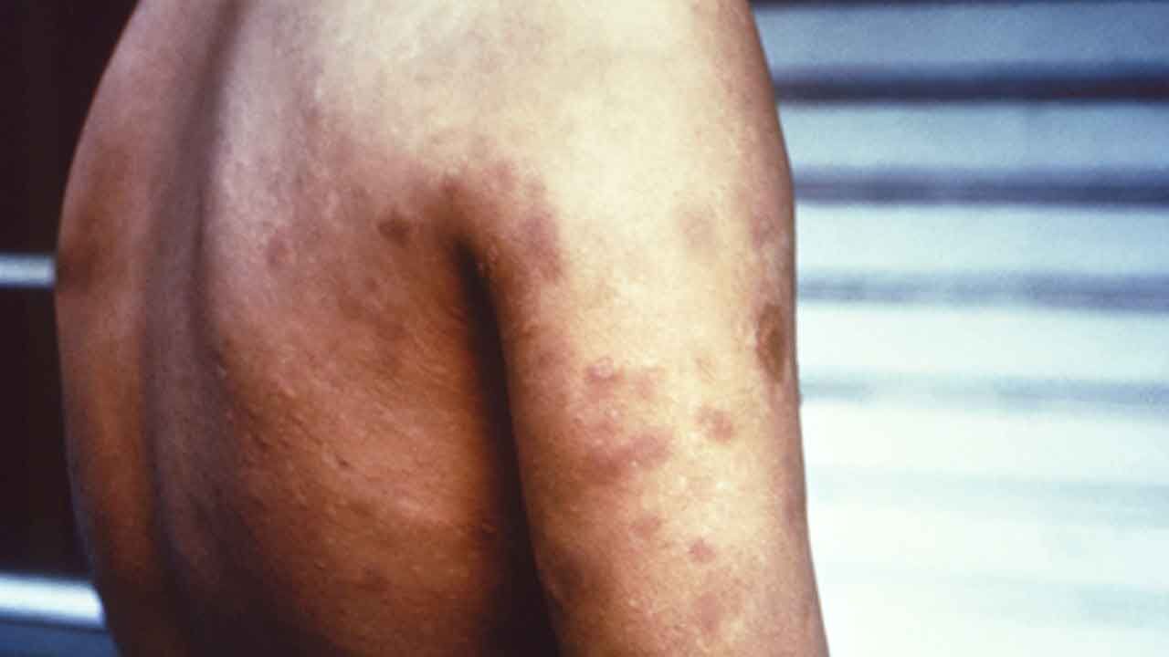 Maharashtra Declares Leprosy as Notifiable Disease to Enhance Control Efforts