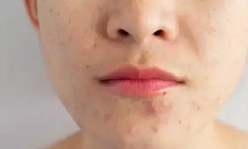 Changing Weather Causing Acne? 5 Skincare Hacks You Need This Season For a Clear, Acne-Free Glow