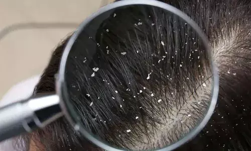 Common Dandruff Myths You Should Stop Believing Right Now