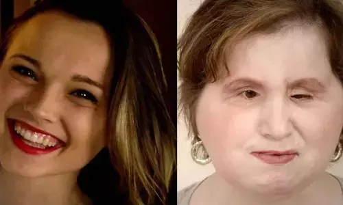 Many doubts about face transplantation remain unanswered 20 years on