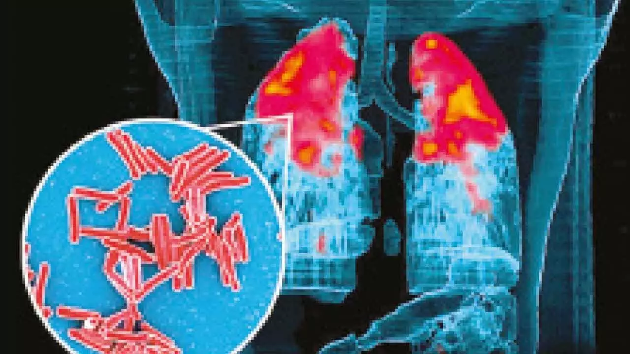 IIT Bombay study shows how TB bacteria shield themselves from antibiotics, stay alive longer IIT Bombay study shows how TB bacteria shield themselves from antibiotics, stay alive longer