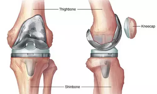 India needs more skilled surgeons for revision knee, hip replacement surgeries, say experts