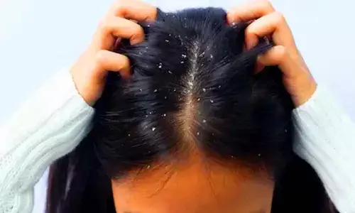 How to Get Rid of Dandruff Naturally: Effective Home Remedies for a Flake-Free Scalp How to Get Rid of Dandruff Naturally: Effective Home Remedies for a Flake-Free Scalp