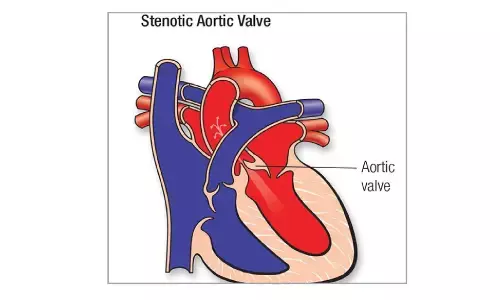 Doctors stress early diagnosis and growing access to advanced therapy Doctors stress early diagnosis and growing access to advanced therapy