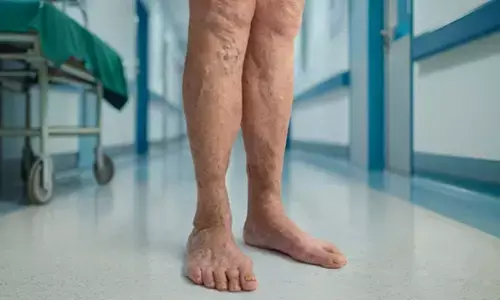 How Untreated Varicose Veins Can Lead to Leg Ulcers, Clots, and Skin Damage]