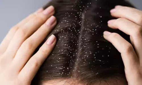 Winter Woes: Beat Dandruff and Hair Fall with Simple Home Remedies