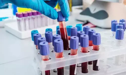 Simple blood test may spot alzheimer’s early: Study