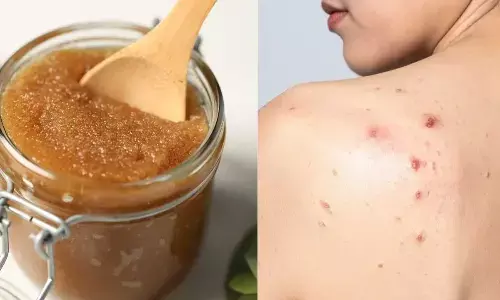 Natural DIY Body Scrubs To Fight Body Acne And Reveal Clear Skin