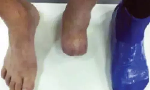 Youth amputates foot to seek disability quota in admission to medical college