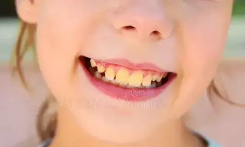 Yellow Plaque: The Silent Threat to Your Smile