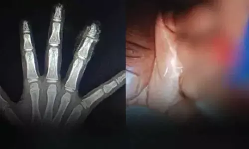 Class I student loses fingers in mid-day meal mishap