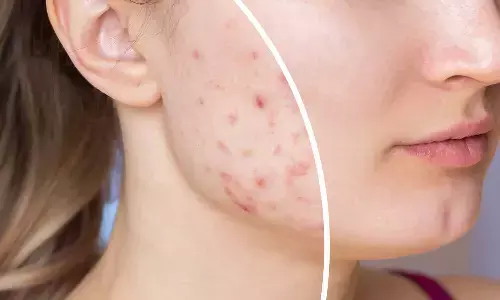 Simple Morning Drink That May Help Fight Stubborn Acne Naturally