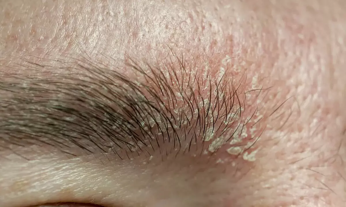 Simple Home Fixes For Eyebrow Dandruff Simple Home Fixes For Eyebrow Dandruff