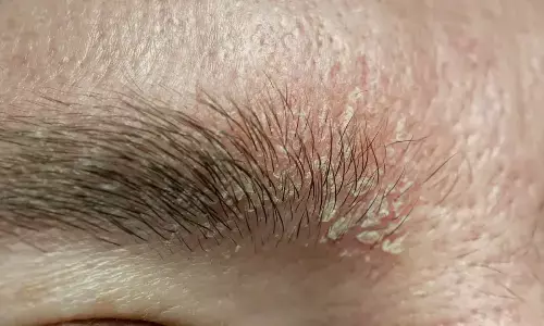 Simple Home Fixes For Eyebrow Dandruff