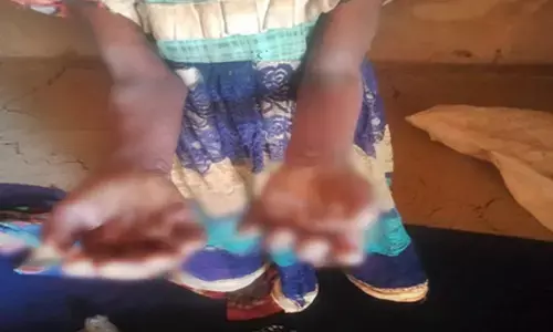 Digvijaya Singh flags skin disease outbreak among children in MPs Betul, seeks urgent action