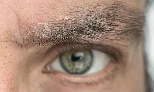 Simple Home Remedies To Tackle Eyebrow Dandruff Naturally