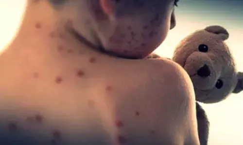 Measles outbreak intensifies in Bangladesh amid rising infections