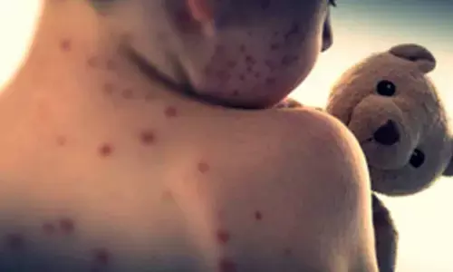 Bangladesh measles outbreak death toll climbs to 499 after 11 more fatalities