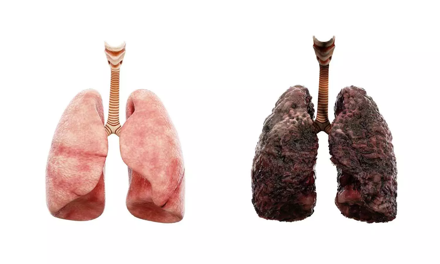 Gujarat and Karnataka Report Steady Rise in Lung Cancer Cases