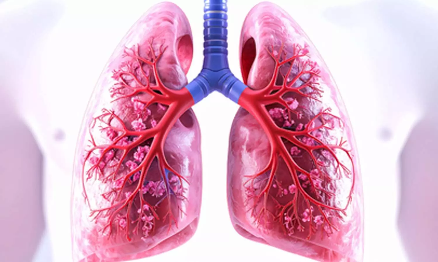 Gujarat sees steady rise in lung cancer cases, tobacco remains key risk factor Gujarat sees steady rise in lung cancer cases, tobacco remains key risk factor