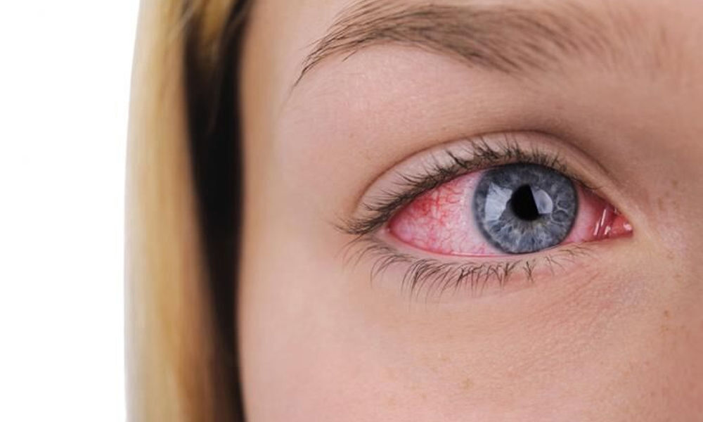 Migraine raises risk of dry eyes: Study