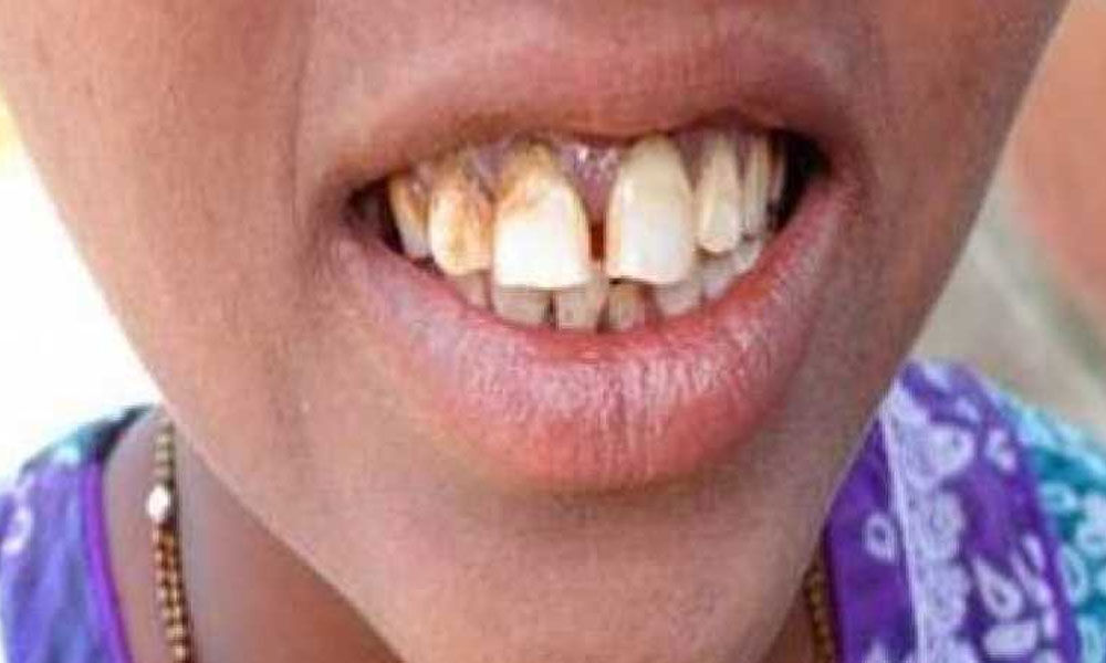 UK university students to give dental health help to Indias poor