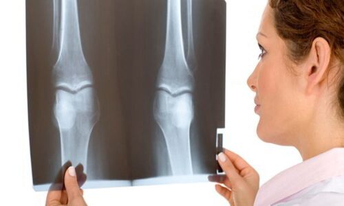 Decoded: How does oestrogen protect bones?