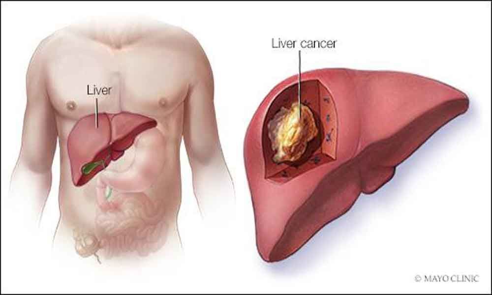 Hormone that protects women from liver cancer