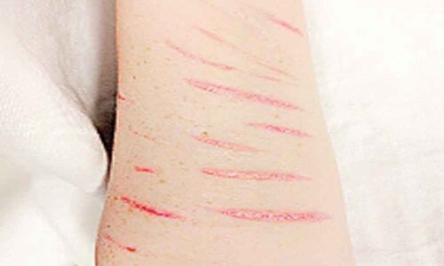 Non-suicidal self-injury associated with impulsive behaviour