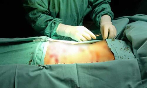 Novel app may predict hernia risk after abdominal surgery