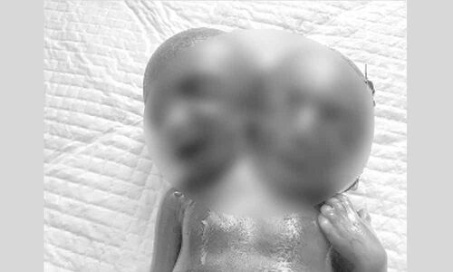 Mother doing well post the procedure