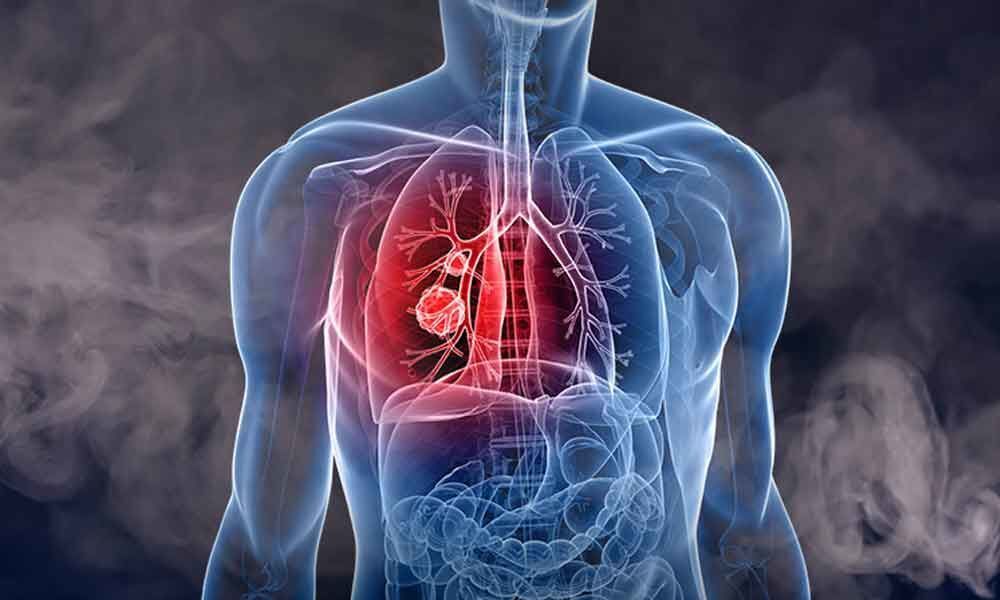 Novel model to predict lung cancer survival developed