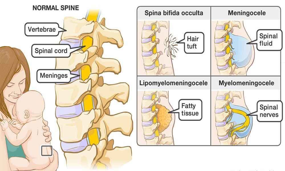 5% of newborns have split spine defect