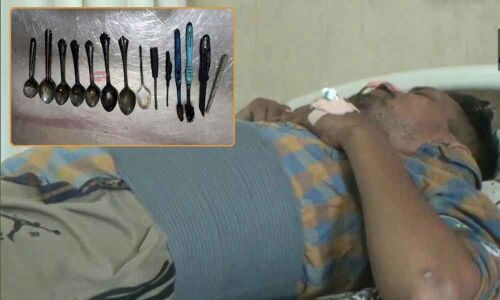 Surgeons remove 8 Spoons, Knife, 2 Toothbrushes from a Mans stomach