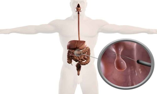 Endoscopic resection of early cancers effective