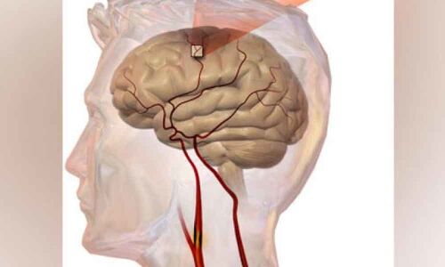 Women less prone to minor strokes