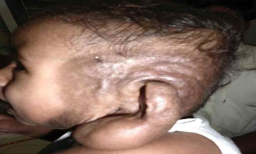 Rare ear surgery performed