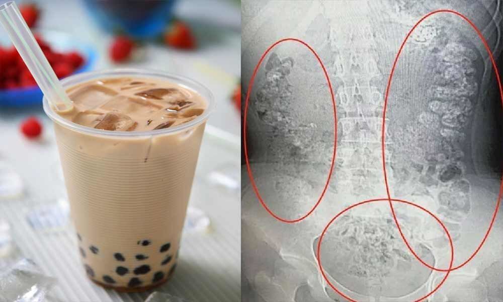 Hundreds of Bubble Tea Balls Get Trapped in a Girls Stomach