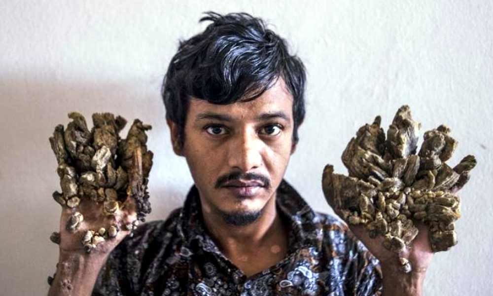 Bangladesh Tree Man wants hands amputated to relieve pain