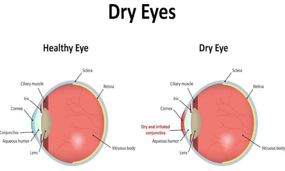 Women at high risk of dry eyes during menopause