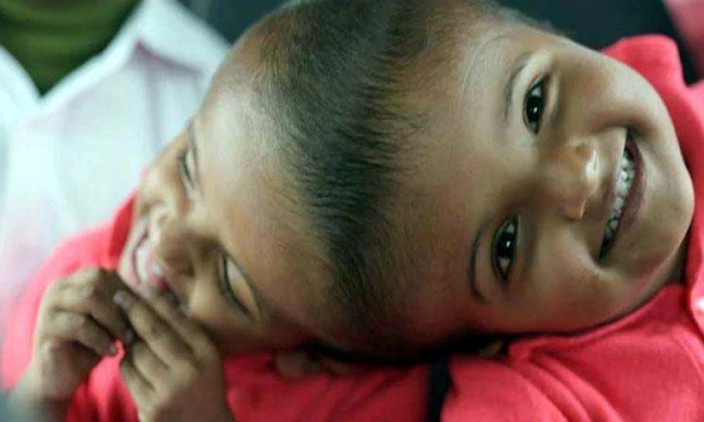 Bangladeshi conjoined twins stable after separation post operation by Hungarian doctors