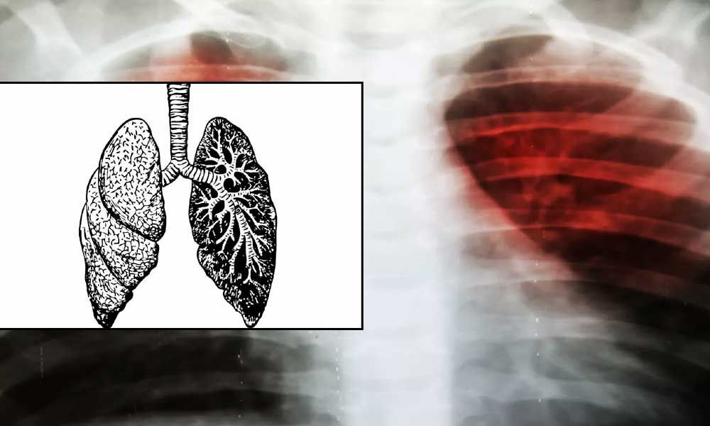 TB survivors at higher risk of developing lung damage