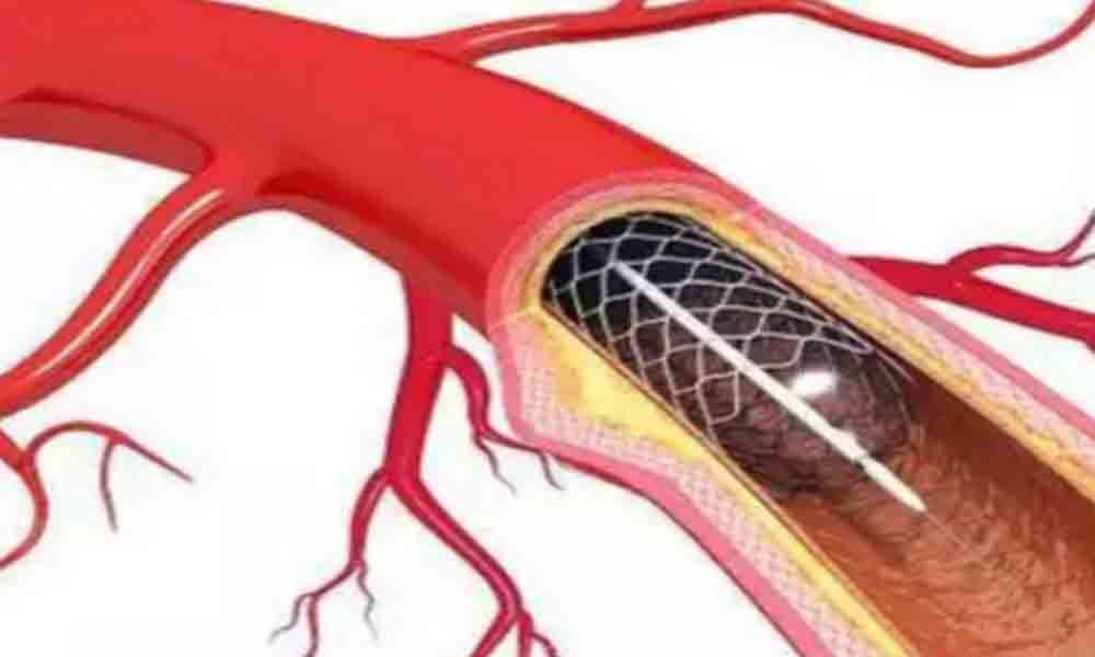 Worlds smallest stent developed by scientists