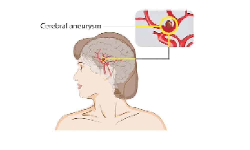 Latest tech useful to treat aneurysm