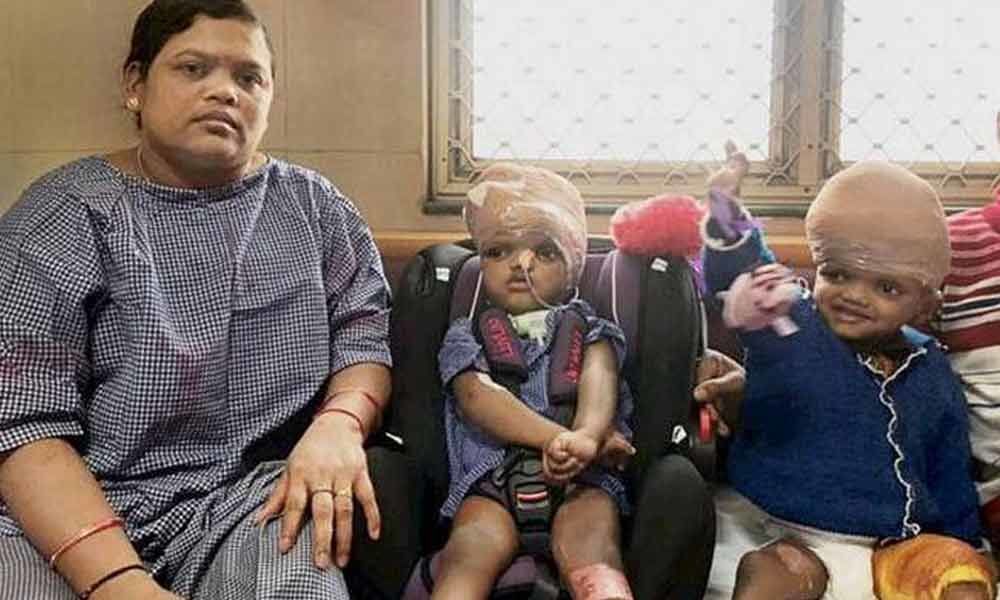 Odishas Conjoined Twins To Return Home 2 Years After Separation